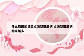 什么原因能導致點滴型銀屑病 點滴型銀屑病越來越多