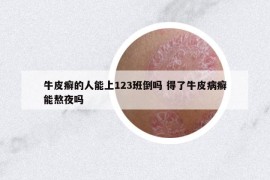 牛皮癬的人能上123班倒嗎 得了牛皮病癬能熬夜嗎