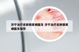 濟(jì)寧治療皮膚銀屑病醫(yī)生 濟(jì)寧治療皮膚銀屑病醫(yī)生推薦