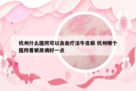 杭州什么醫(yī)院可以自血療法牛皮癬 杭州哪個(gè)醫(yī)院看銀屑病好一點(diǎn)