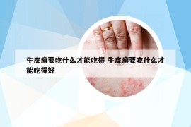 牛皮癬要吃什么才能吃得 牛皮癬要吃什么才能吃得好