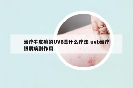 治療牛皮癬的UVB是什么療法 uvb治療銀屑病副作用