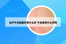 治療牛皮廨最好用什么藥 牛皮廨用什么藥物
