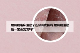銀屑病臨床治愈了還會有皮損嗎 銀屑病治愈后一定會復發(fā)嗎?