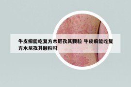 牛皮癬能吃復(fù)方木尼孜其顆粒 牛皮癬能吃復(fù)方木尼孜其顆粒嗎