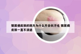 銀屑病皮損的地方為什么不會(huì)長(zhǎng)汗毛 銀屑病皮損一直不消退