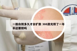 一般白斑多久才會(huì)擴(kuò)散 308激光照了一年半還要照嗎