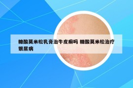 糠酸莫米松乳膏治牛皮癬嗎 糠酸莫米松治療銀屑病