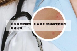 銀屑病生物制劑一針好多久 銀屑病生物制劑幾針見效