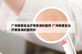 廣州哪里能治療銀屑病的醫(yī)院 廣州哪里能治療銀屑病的醫(yī)院好