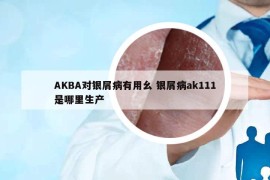 AKBA對銀屑病有用幺 銀屑病ak111是哪里生產(chǎn)