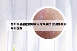 蘭州銀屑病醫(yī)院哪家治療效果好 蘭州牛皮癬專科醫(yī)院
