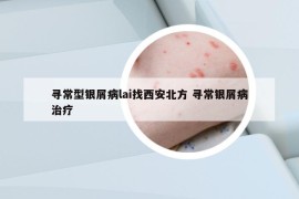 尋常型銀屑病lai找西安北方 尋常銀屑病治療