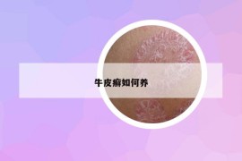 牛皮癬如何養(yǎng)