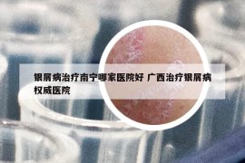 銀屑病治療南寧哪家醫(yī)院好 廣西治療銀屑病權(quán)威醫(yī)院