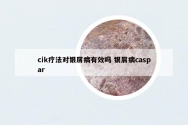 cik療法對(duì)銀屑病有效嗎 銀屑病caspar