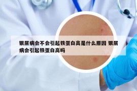銀屑病會不會引起鐵蛋白高是什么原因 銀屑病會引起鐵蛋白高嗎