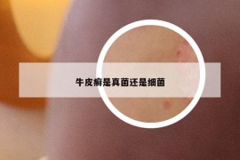 牛皮癬是真菌還是細菌