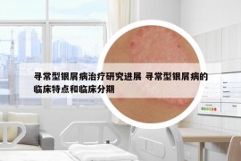 尋常型銀屑病治療研究進(jìn)展 尋常型銀屑病的臨床特點(diǎn)和臨床分期