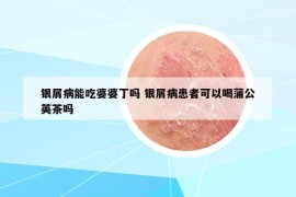 銀屑病能吃婆婆丁嗎 銀屑病患者可以喝蒲公英茶嗎