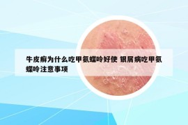 牛皮癬為什么吃甲氨蝶呤好使 銀屑病吃甲氨蝶呤注意事項