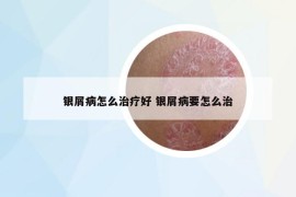 銀屑病怎么治療好 銀屑病要怎么治