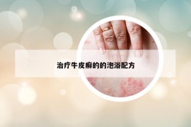 治療牛皮癬的的泡浴配方