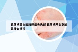 銀屑病是先四肢還是先頭部 銀屑病從頭到腳是什么情況