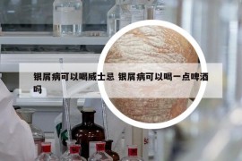 銀屑病可以喝威士忌 銀屑病可以喝一點啤酒嗎