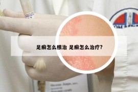 足癬怎么根治 足癬怎么治療?