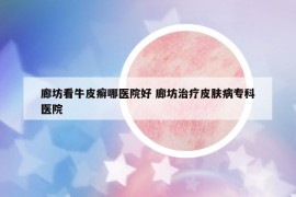 廊坊看牛皮癬哪醫(yī)院好 廊坊治療皮膚病專科醫(yī)院