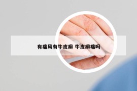 有痛風有牛皮癬 牛皮癬痛嗎