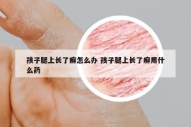 孩子腿上長了癬怎么辦 孩子腿上長了癬用什么藥