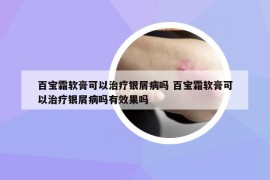 百寶霜軟膏可以治療銀屑病嗎 百寶霜軟膏可以治療銀屑病嗎有效果嗎
