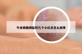 牛皮癬胳膊起好幾個小紅點(diǎn)怎么回事