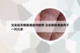 父親后天銀屑病遺傳規(guī)律 父親銀屑病遺傳下一代幾率
