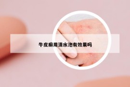牛皮癬用清水泡有效果嗎
