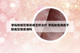 掌跖膿皰型銀屑病怎樣治療 掌跖膿皰病屬于膿皰型銀屑病嗎