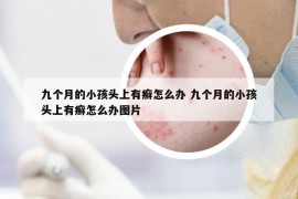 九個月的小孩頭上有癬怎么辦 九個月的小孩頭上有癬怎么辦圖片
