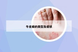 牛皮癬的類型及癥狀