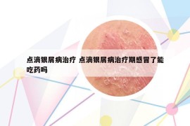 點滴銀屑病治療 點滴銀屑病治療期感冒了能吃藥嗎