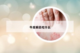 牛皮癬忌吃什么