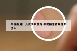 牛皮癬用什么洗頭發(fā)最好 牛皮癬患者用什么洗頭