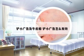 鏟小廣告及牛皮癬 鏟小廣告怎么有效