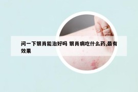 問一下銀肖能治好嗎 銀肖病吃什么藥,最有效果