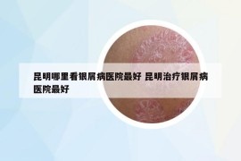 昆明哪里看銀屑病醫(yī)院最好 昆明治療銀屑病醫(yī)院最好