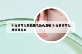 牛皮癬可以用硫磺皂洗頭發(fā)嘛 牛皮膚癬可以用硫磺皂么