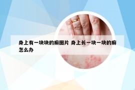 身上有一塊塊的癬圖片 身上長一塊一塊的癬怎么辦