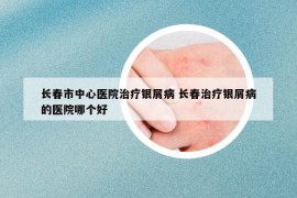 長(zhǎng)春市中心醫(yī)院治療銀屑病 長(zhǎng)春治療銀屑病的醫(yī)院哪個(gè)好