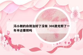 馮小剛的白斑治好了沒(méi)有 308激光照了一年半還要照嗎